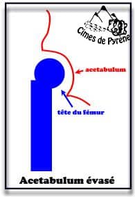 Acetabulum trop évasé