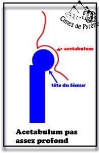 Acetabulum trop serré
