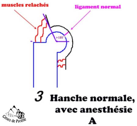 Bonne hanche avec anesthésie