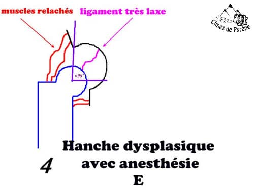 Hanche laxe, sans anesthésie