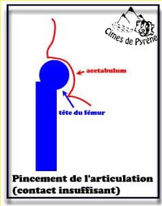 Articluationpincée