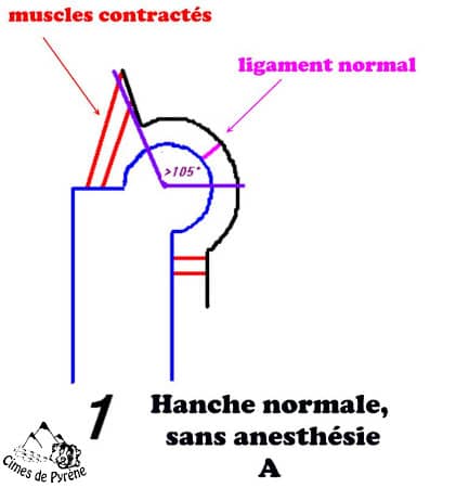 Bonne hanche sans anesthésie