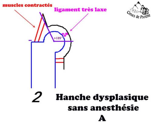 Hanche laxe sans anesthésie