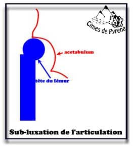 Subluxation